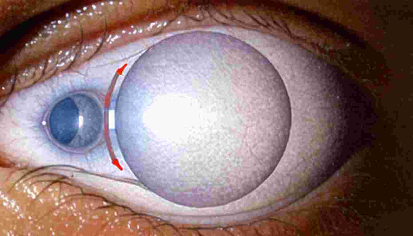 Anatomical Considerations for Myringotomy