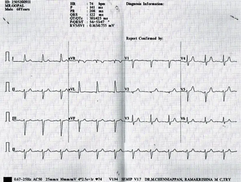 A Journey Through Interesting ECGs (Part-1)