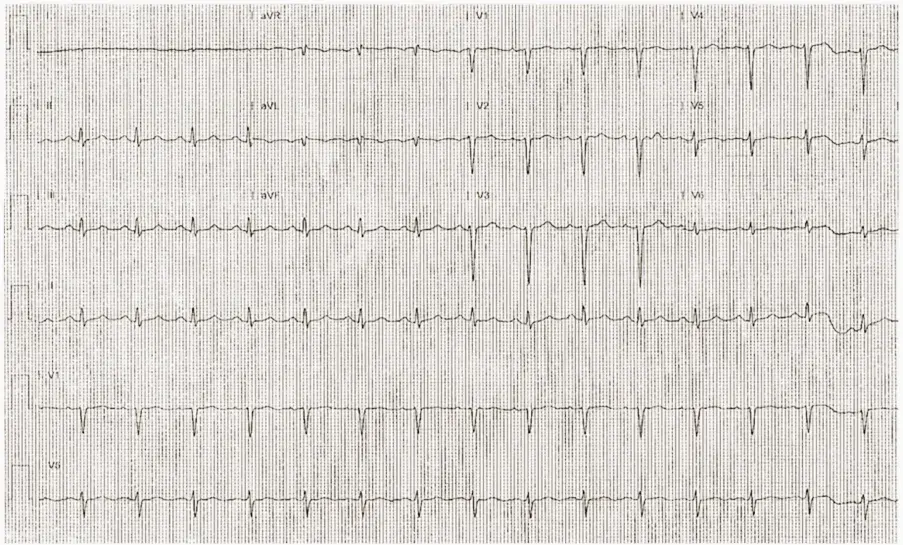 A Journey Through Interesting ECGs (Part-2)