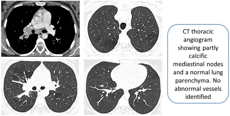 A Curious Case of Hemoptysis – Thinking Out of The Box