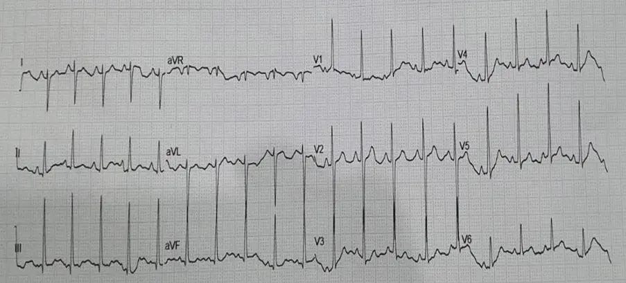Tetralogy of Fallot with Pulmonary Hyperemia