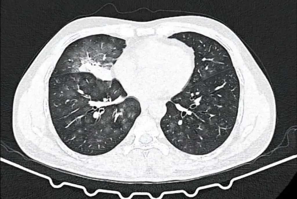 There is always a way; if there isn’t, make one! – IP (Interstitial Pulmonary diseases) beyond barriers